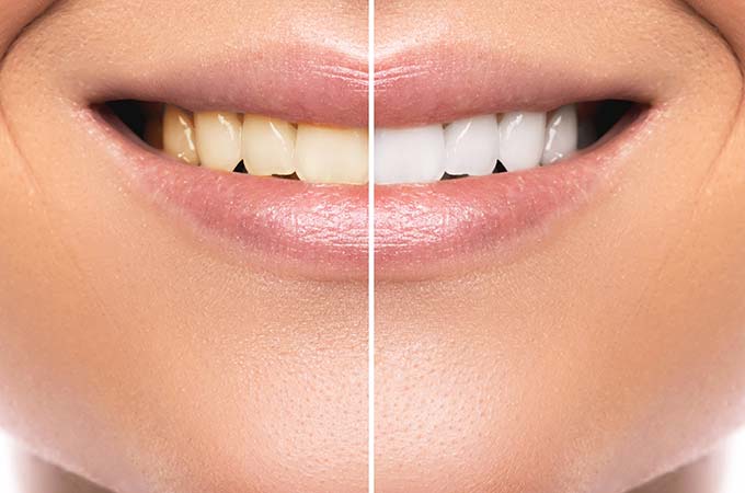 Comparison after teeth whitening