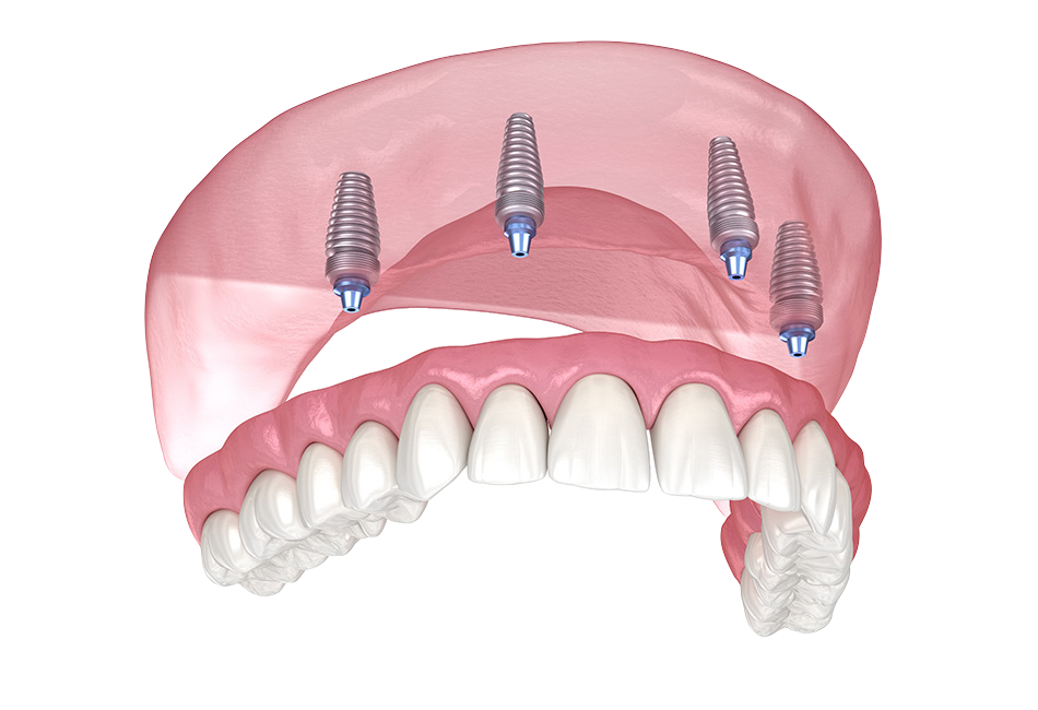 Single & Full-Arch Dental Implants